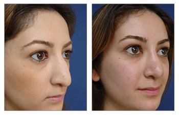 closed rhinoplasty procedure