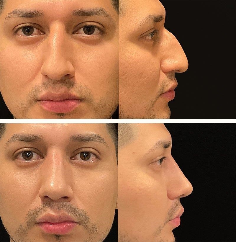 closed rhinoplasty procedure